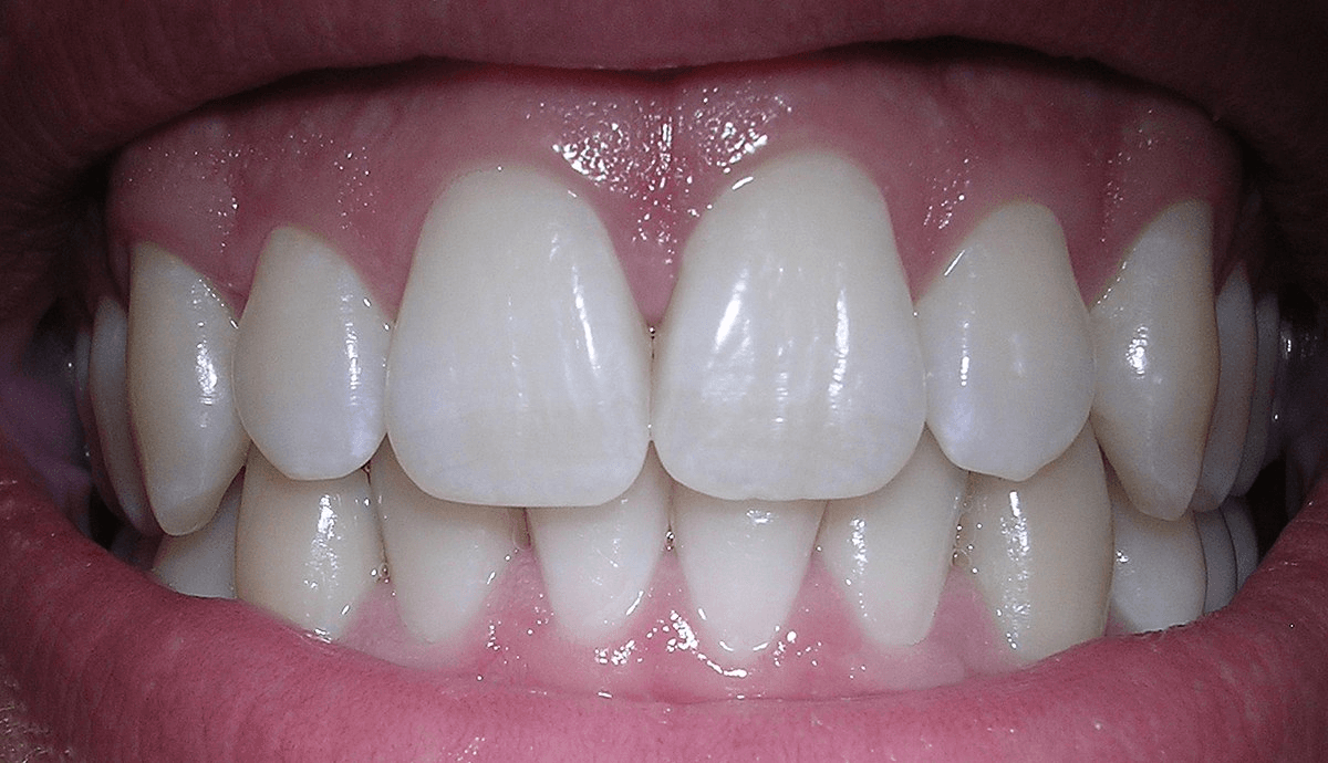 After treatment